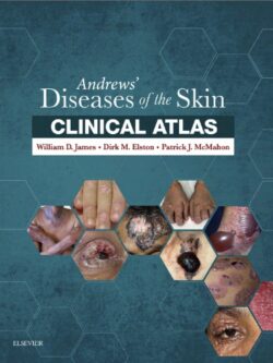 Andrews’ Diseases of the Skin Clinical Atlas - eBook