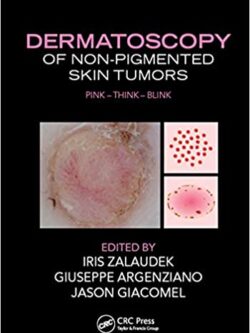 Dermatoscopy of Non-Pigmented Skin Tumors